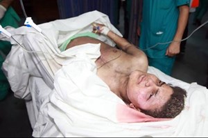 محدث: 156 شهيداً وأكثر من 1078 جريحاً منذ بدء العدوان 